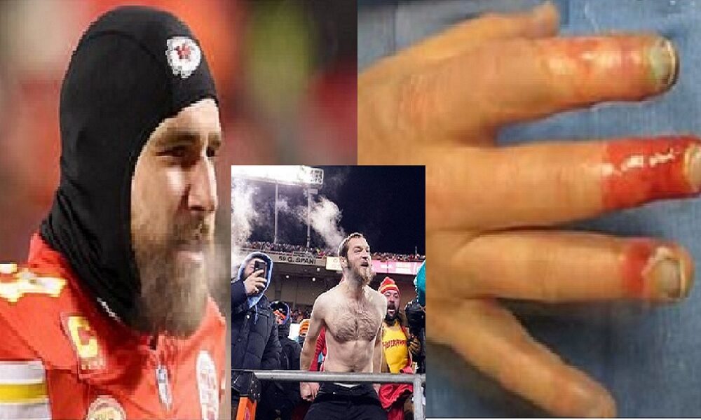 MASSIVE UPROAR as Kansas City Chiefs fans need AMPUTATIONS from frostbite after sitting through negative 27 wind chill to cheer Travis Kelce team in January 13 playoff game vs Miami Dolphins