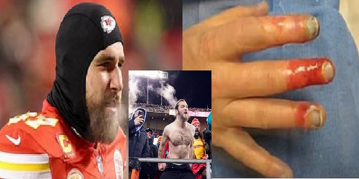MASSIVE UPROAR as Kansas City Chiefs fans need AMPUTATIONS from frostbite after sitting through negative 27 wind chill to cheer Travis Kelce team in January 13 playoff game vs Miami Dolphins